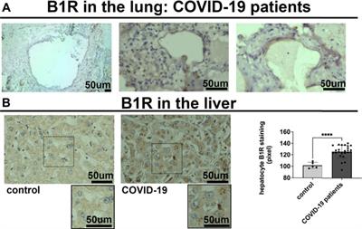 The des-Arg9-bradykinin/B1R axis: Hepatic damage in COVID-19